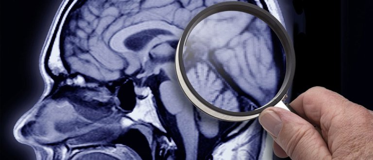 Dementia Will Be a Treatable Condition in 10 Years