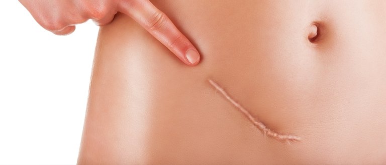The End of Scars: Scientists Discovered How to Regenerate Human Skin