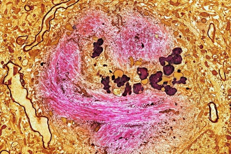 Scientists Are Reversing the Symptoms of Alzheimer’s