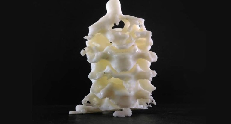Doctors 3D Printed a Replacement for This Woman’s Damaged Spine
