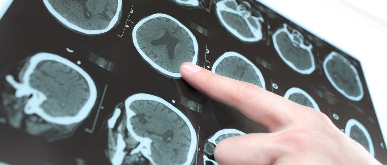 A New Genetic Test Predicts If and When You’ll Develop Alzheimer’s