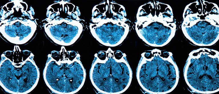 A Drug That Could Slow Parkinson’s and Alzheimer’s Is Heading to Major Testing
