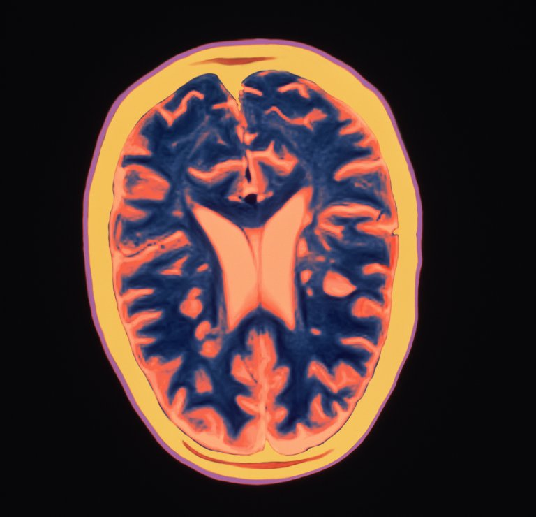 ocrelizumab ms primary progressive ms