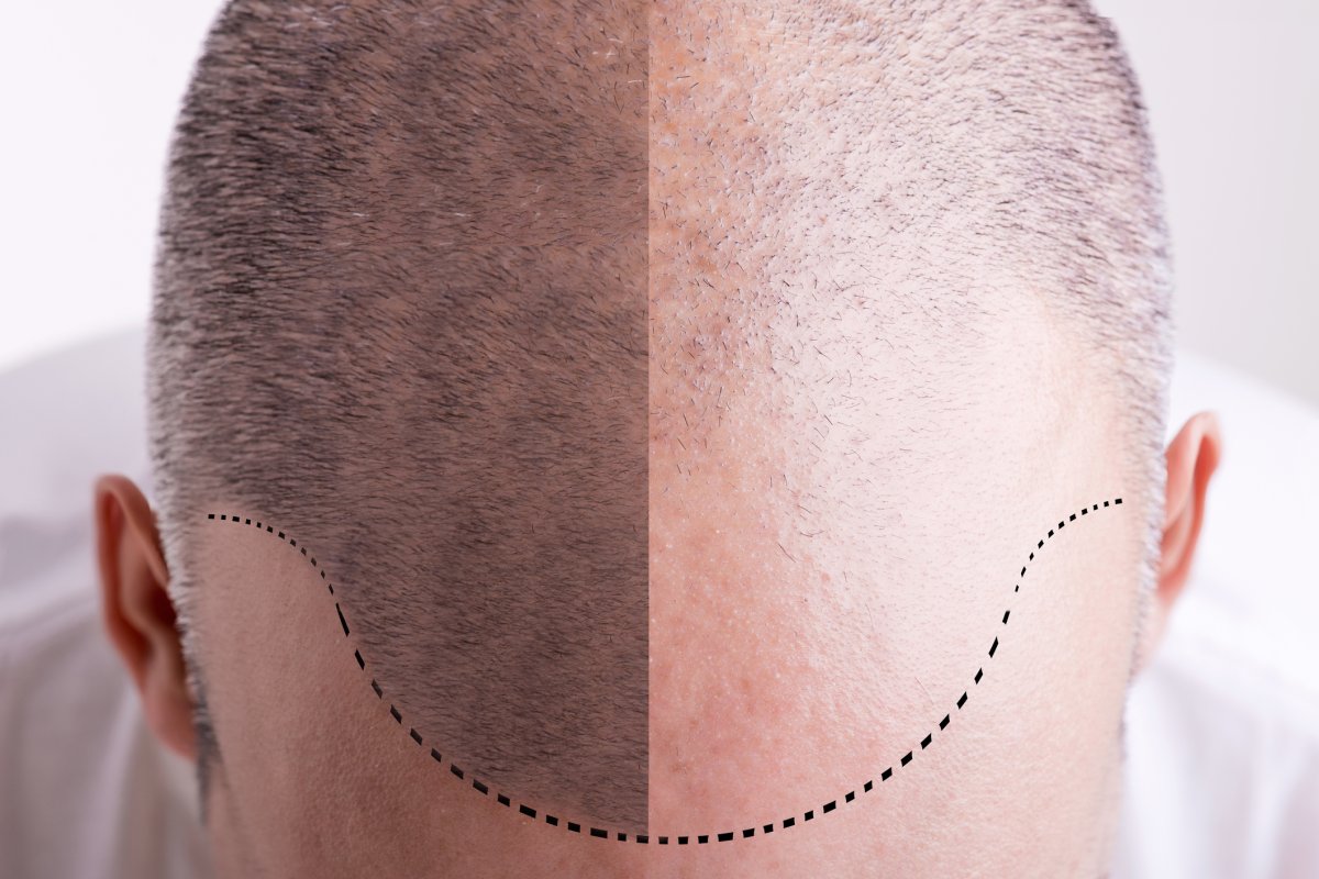 New “Bodily Regeneration” Research Could End Hair Loss