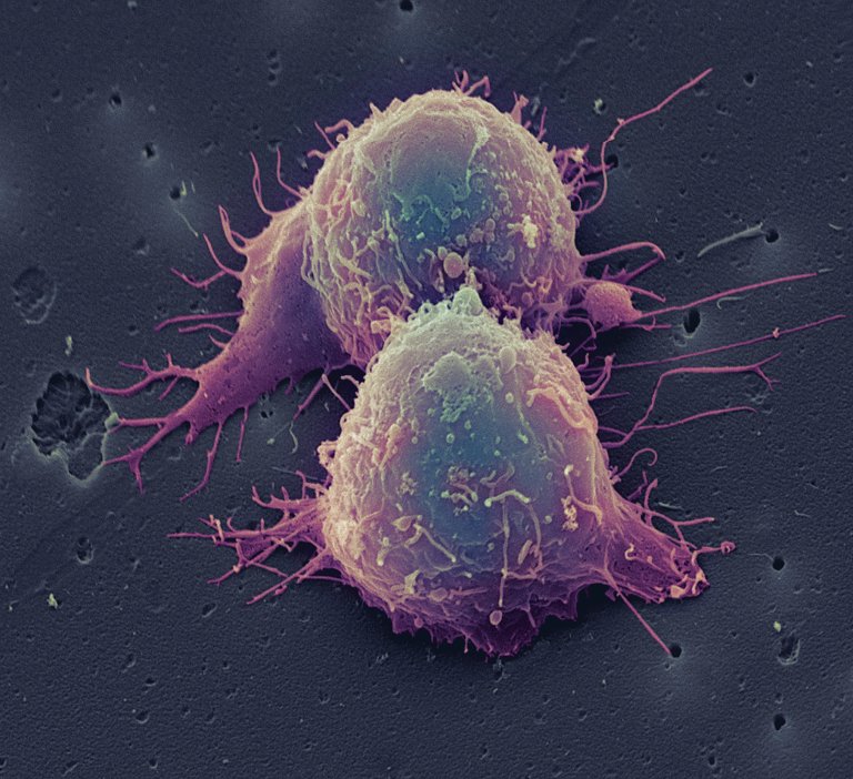cancer treatment immunotherapy keytruda