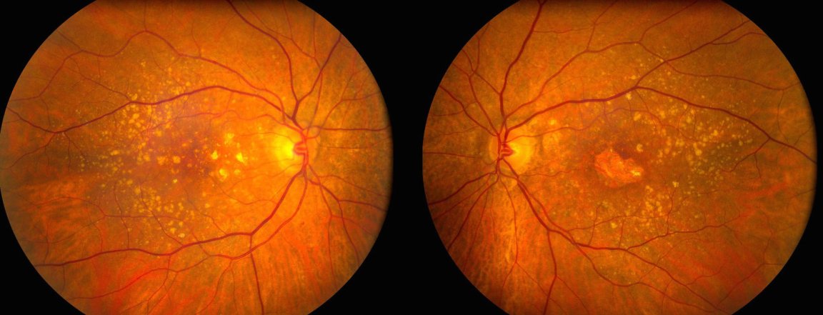 age-related macular degeneration gene therapy wet amd blindness