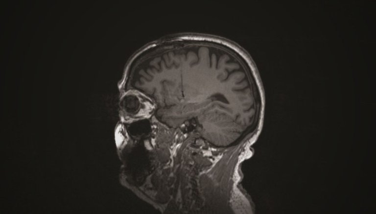 Brain Cells From Pigs Implanted Into Human Brains to Treat Parkinson’s