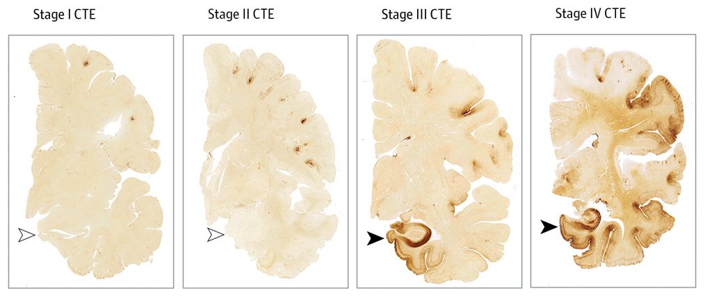 Study of 111 Deceased NFL Players’ Brains Reveals 110 Had the ...