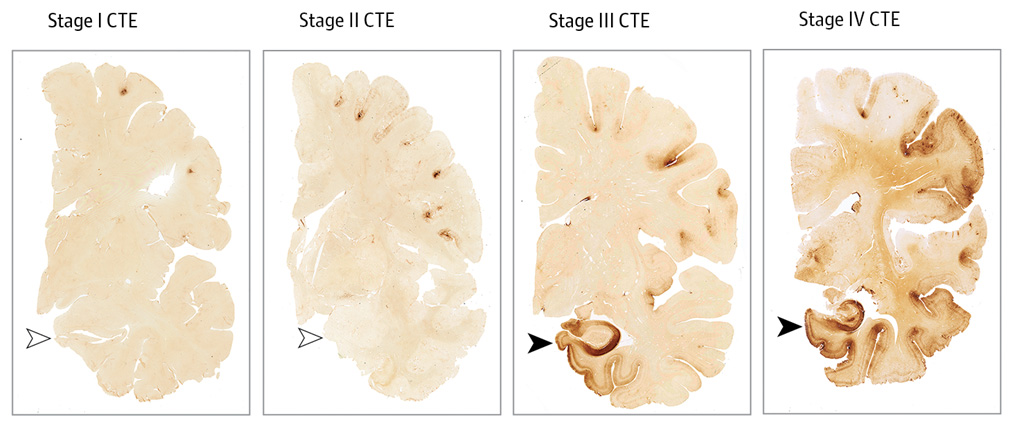 *4* Study Reveals Connection Between American Football and Chronic Traumatic Encephalopathy