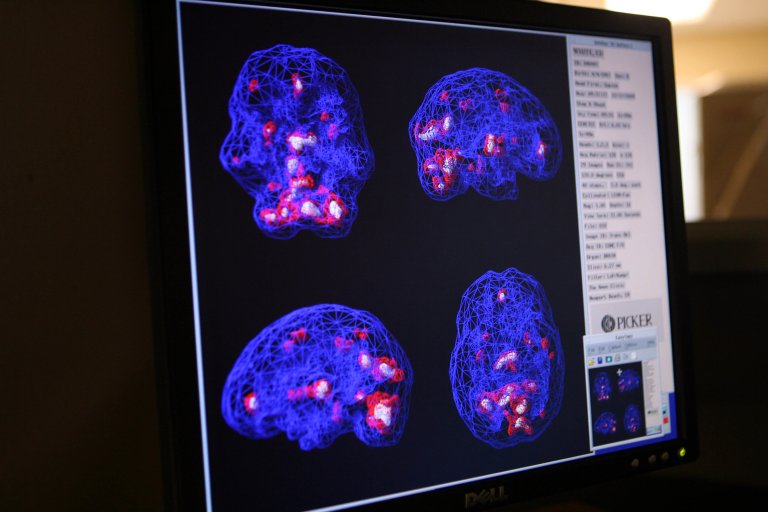 cte chronic traumatic encephalopathy football neuropathology