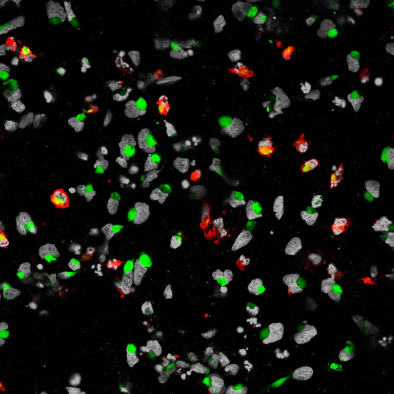 New Research Shows that Zika Virus Kills Brain Cancer Stem Cells
