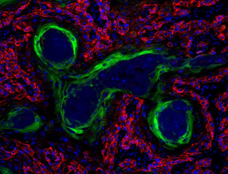 New Low-Cost Cancer Treatment Could Kill Tumors With Ethanol
