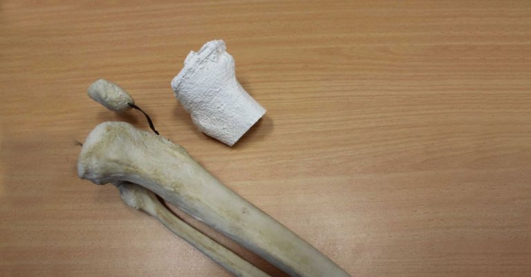 Man Receives World’s First 3D Printed Tibia Replacement