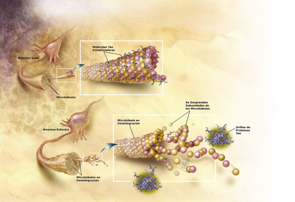Image Credit: Alzheimer's Disease Education and Referral Center/Wikimedia Commons