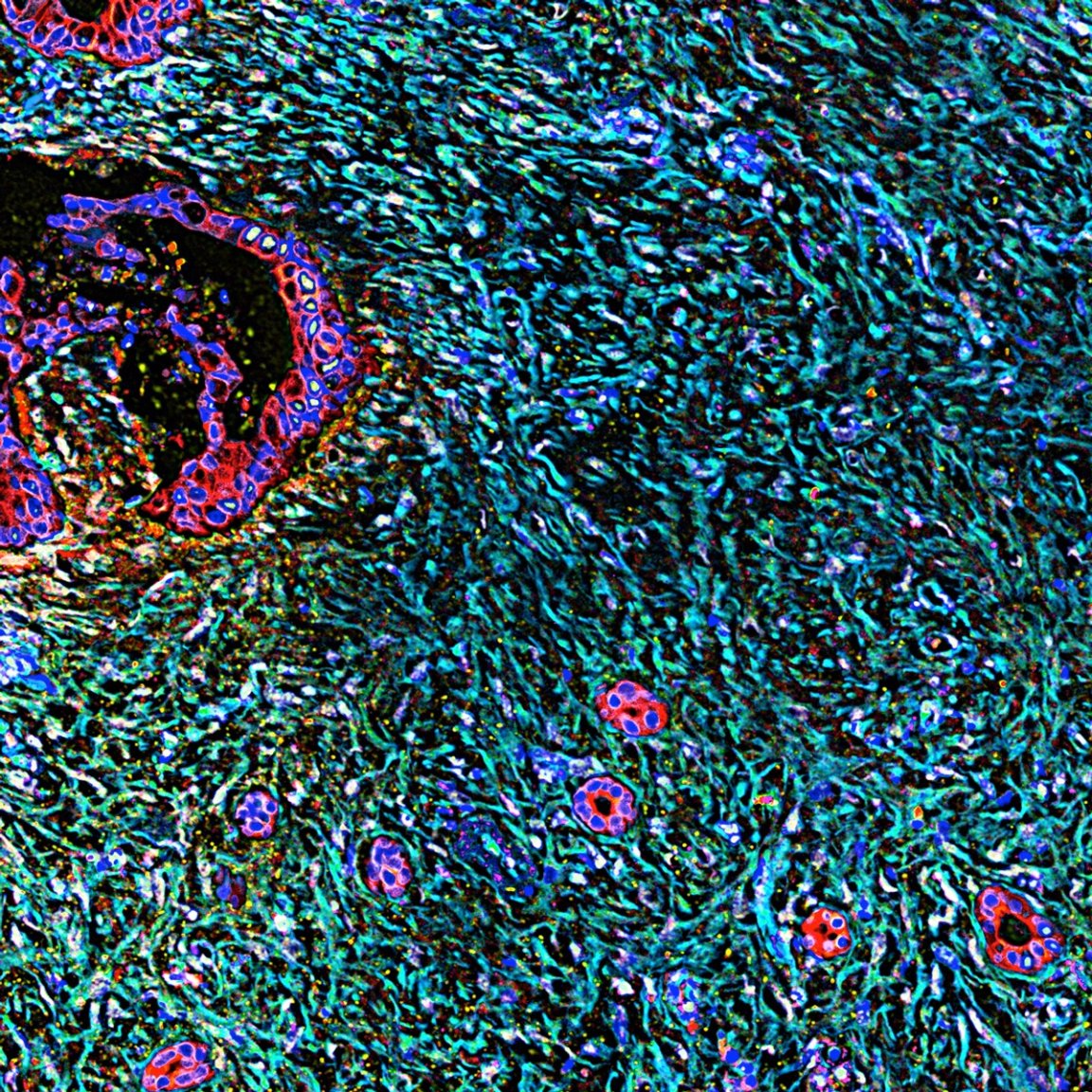 pancreatic cancer exosomes cell communication chemotherapy cancer