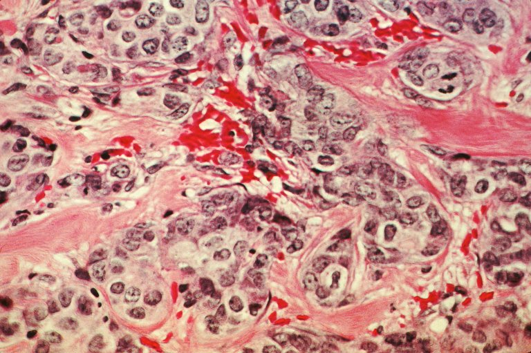 Machine Learning Identifies Breast Lesions Likely to Become Cancer