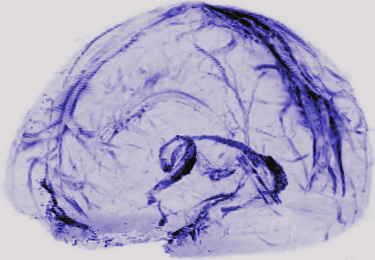 Researchers Discover New Vessel System in the Human Brain