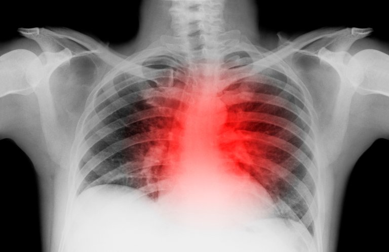 heart attack heart failure heart disease medical treatments