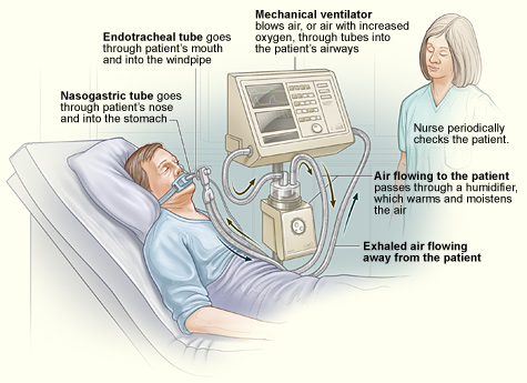 ventilator-breathing-paralysis-breakthrough