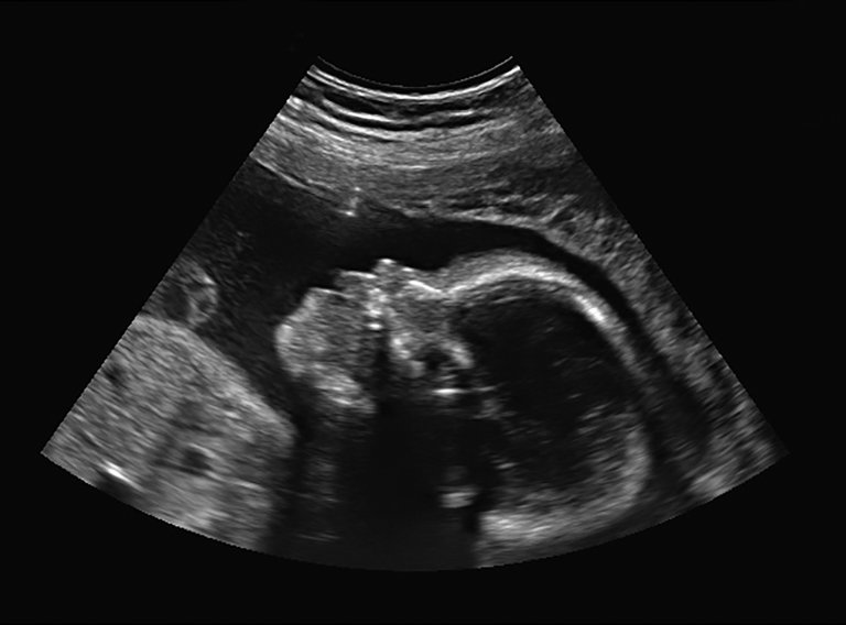 spina bifida myelomeningocele in utero surgery canada
