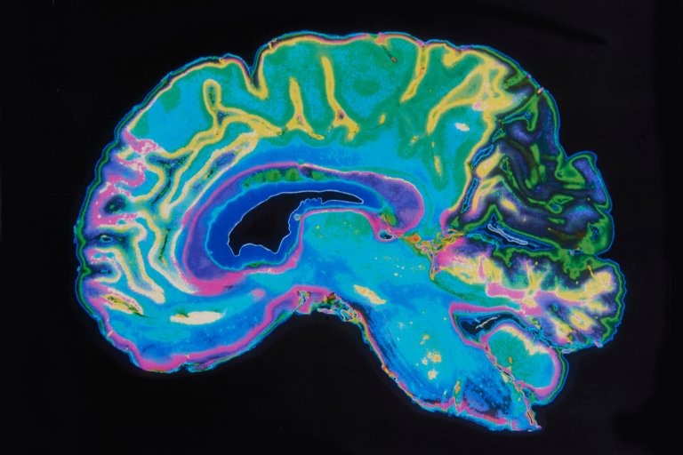 The US Military is Testing Mood Altering, AI-Controlled Brain Implants in Humans
