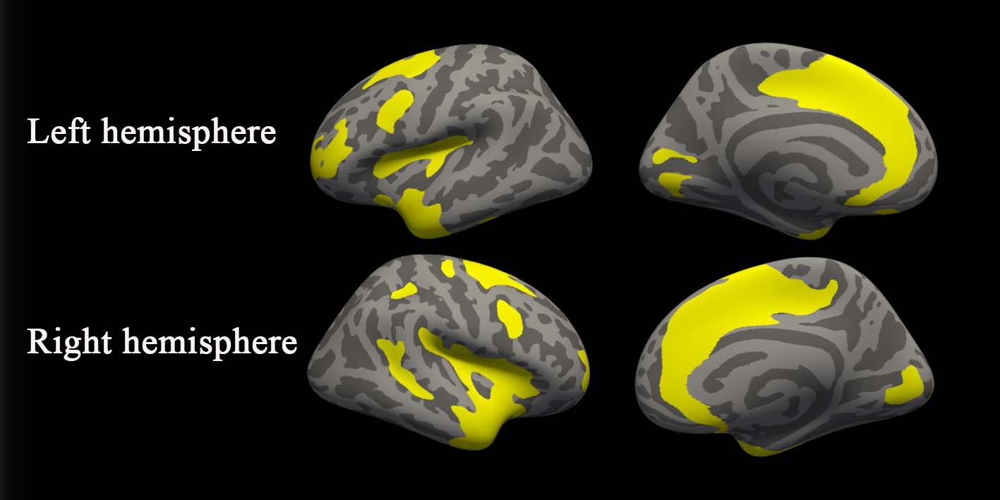Differing cortical thickness. Image Credit: Radiological Society of North America