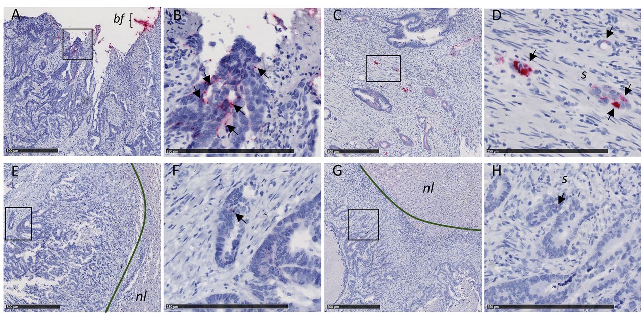 Images of Fusobacteria within colorectal tumors and liver cancer. The discovery has raised new questions about the role of bacteria in cancer.