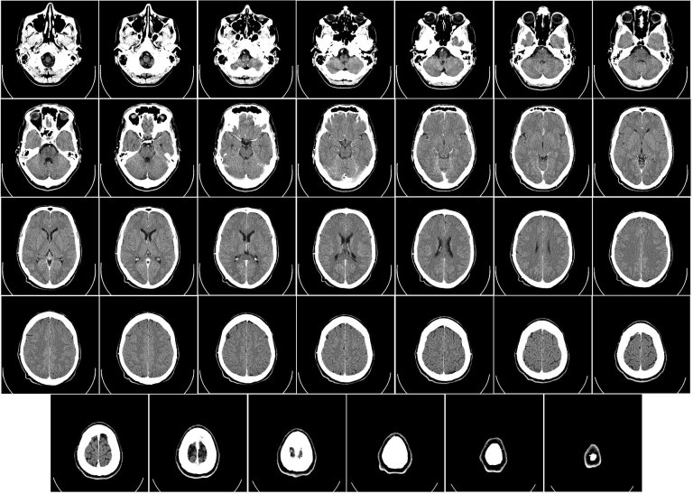Results of Landmark Study Could Change How (and When) We Treat Strokes