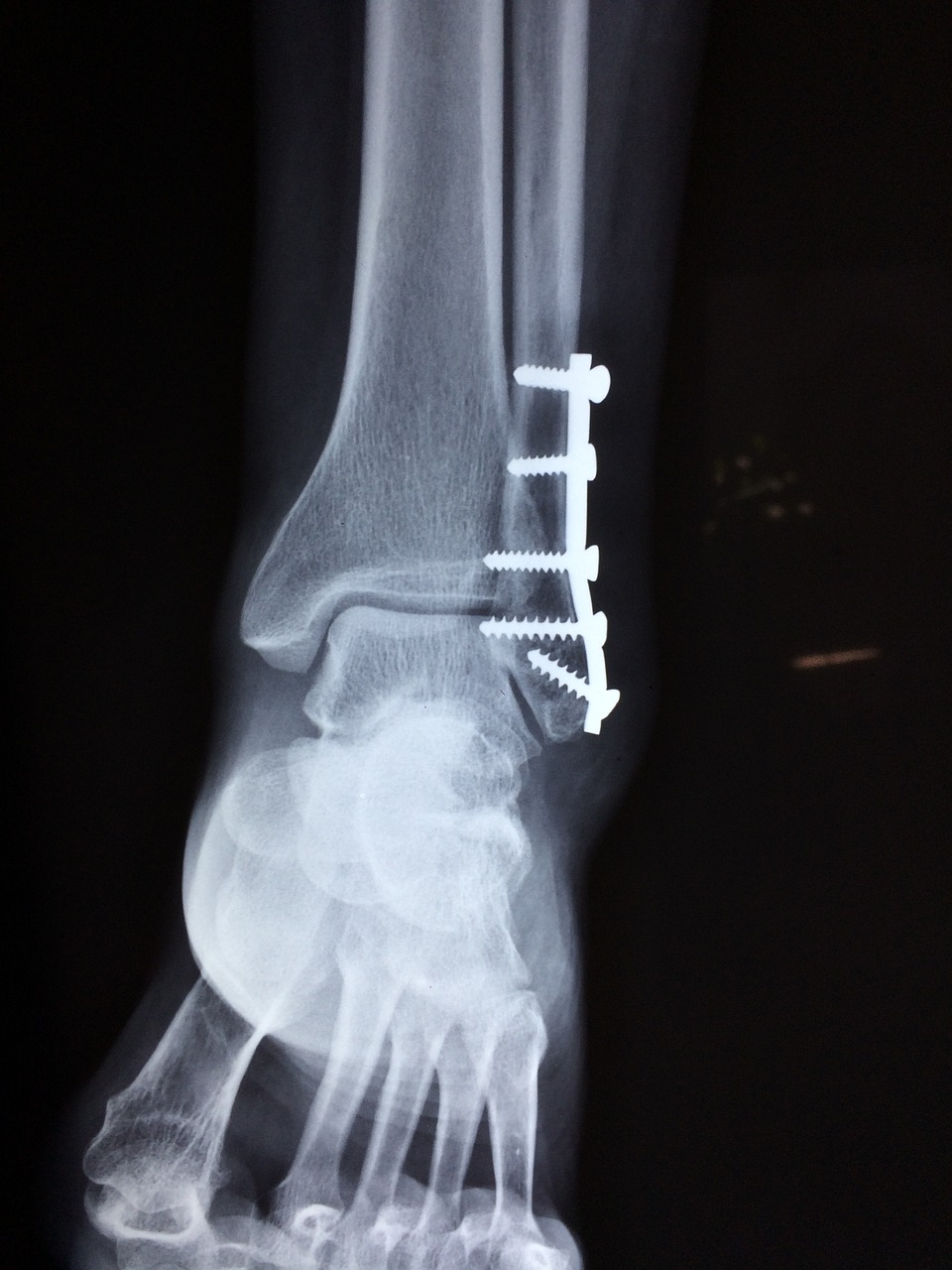 Painful, less effective measure for treating broken bones could soon be in the past. Image Credit: Taokinesis / Pixabay