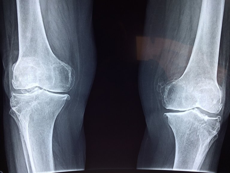 A New Implant Heals Broken Legs by Transforming into Real Bone