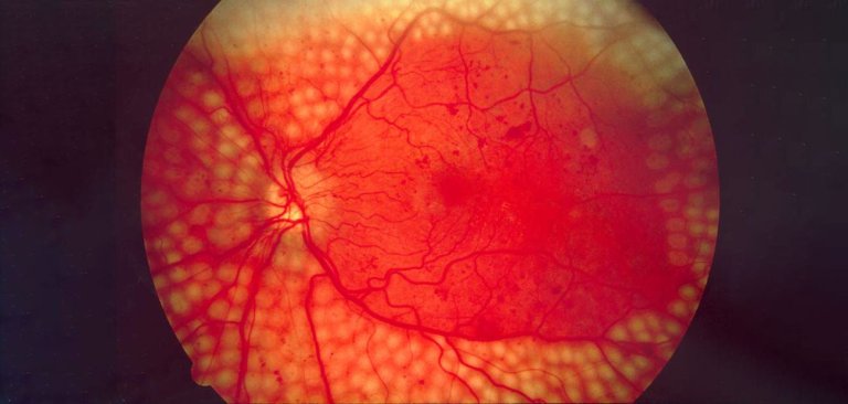 Medical AI May Be Better at Spotting Eye Disease Than Real Doctors