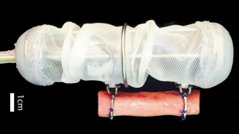 A Robotic Implant Could Treat Congenital Disorders in Babies