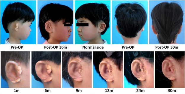 Image showing a child with an underdeveloped ear before and after one of the new ears grew. After 30 months, the new ear looks mostly like a "normal" ear. 