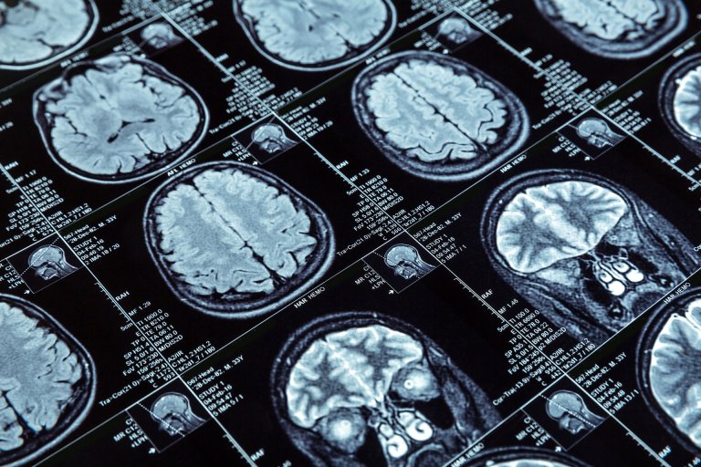 Brain-Zapping Pacemaker Implant Could Be a New Treatment for Opioid Addiction
