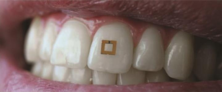 The tooth-mounted sensor, a tiny gold square mounted on a person's front tooth.