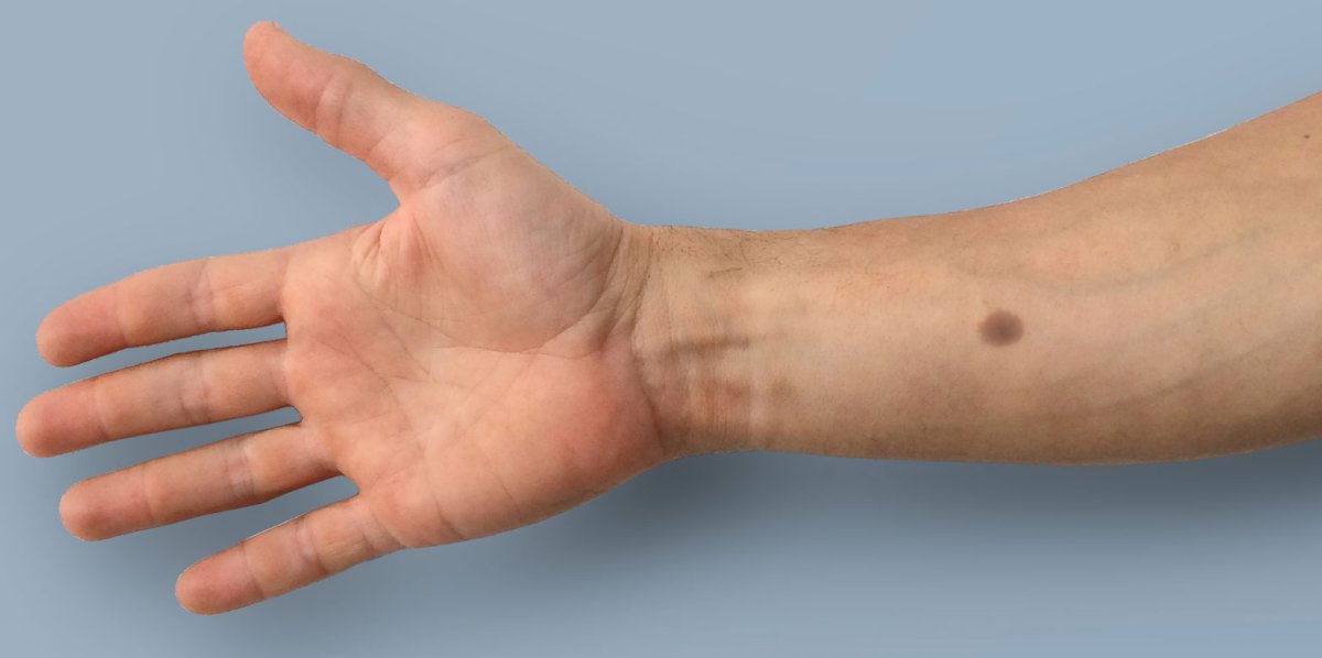 artificial mole