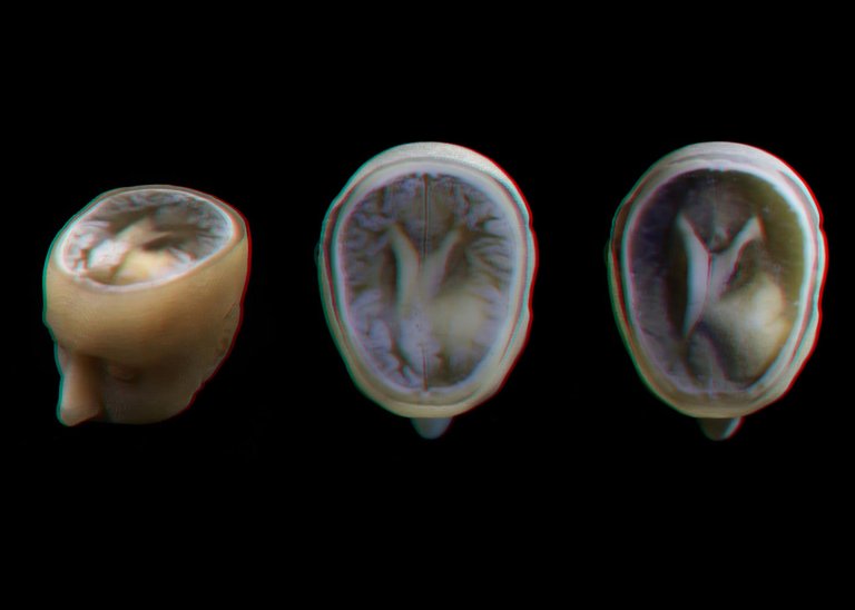 We Can Now Make Super Accurate 3D Printed Models of Patients’ Brains