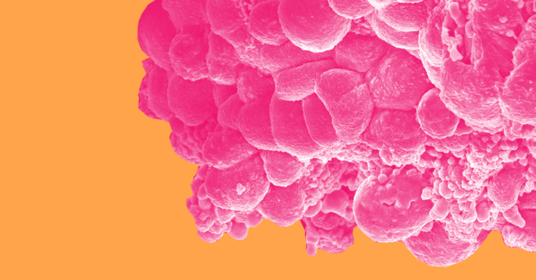 Some Breast Cancer Patients Can Skip Chemo Thanks To New Genetic Insight