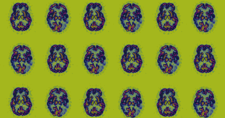 Americans Are Living Longer. That Will Mean More People With Alzheimer’s.