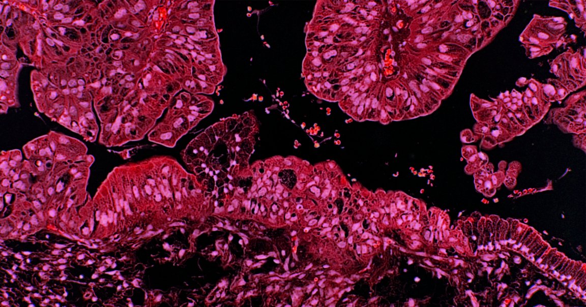 Australia is on track to all but eliminate cervical cancer within its borders by 2066, and the U.S. could follow in its footsteps.