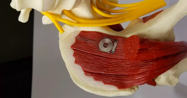 This Wireless Implant Heals Damaged Nerves and Then Self-Destructs