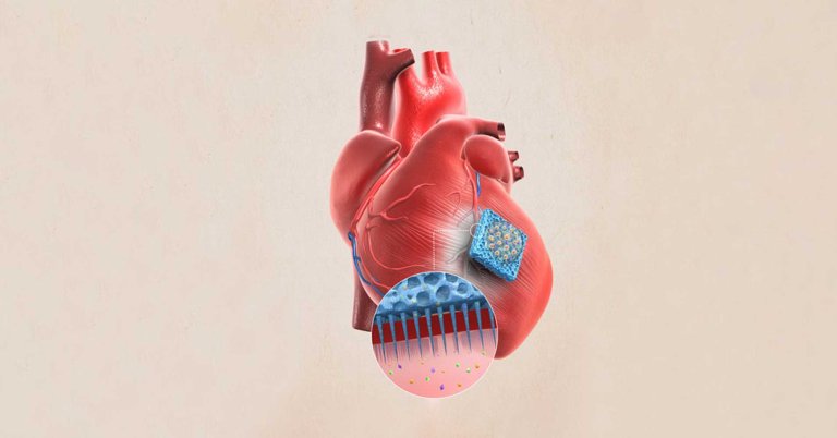 Researchers have created a needle-covered patch that delivers stem cells directly to damaged hearts, helping the organs heal.