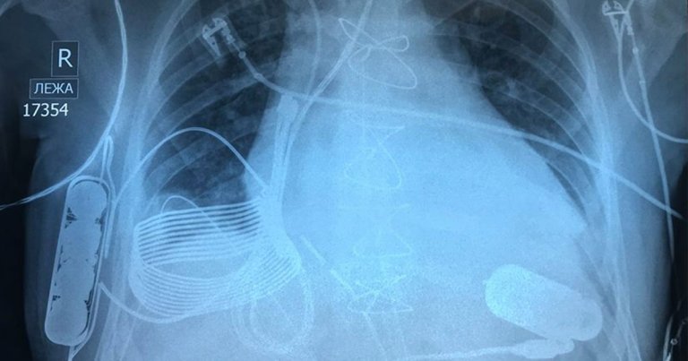 Doctors have implanted the first wireless heart pump in a patient, eliminating the need for him to be connected to a power source via a driveline.