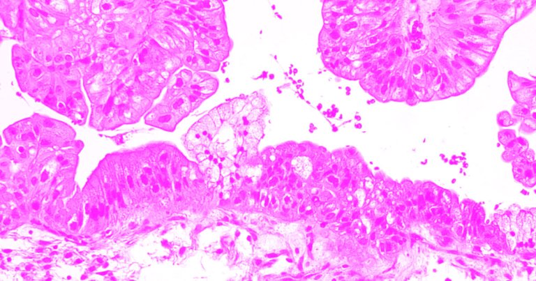 Scientists developed a piece of machine learning software that can predict the prognosis of ovarian cancer and at a higher accuracy.