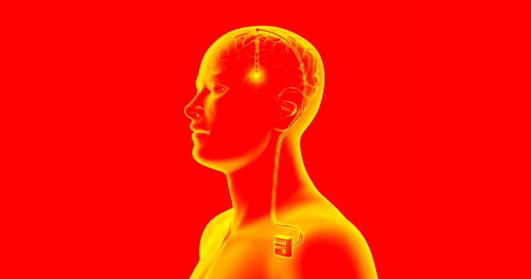 In China, Surgeons Are Treating Addiction With Brain Implants