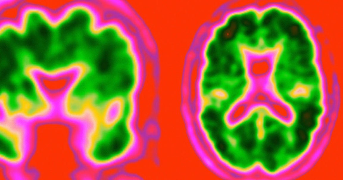 Researchers claim they have made significant progress in developing a blood test that can detect Alzheimer's up to 20 years before any symptoms appear.