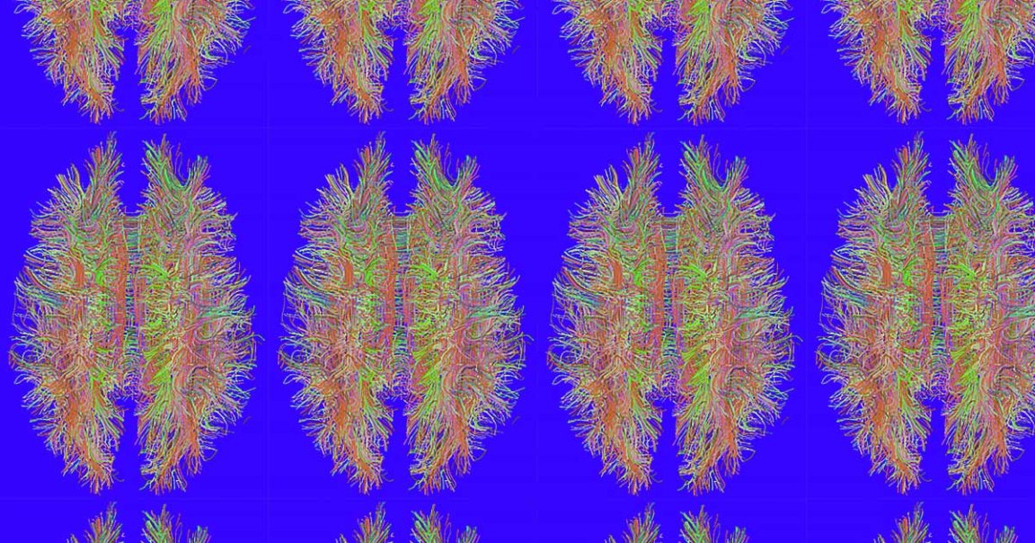 A team of researchers used a type of artificial intelligence (AI) to predict ADHD in patients by having it analyze magnetic resonance imaging (MRI) scans.