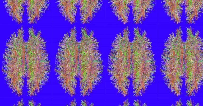 A team of researchers used a type of artificial intelligence (AI) to predict ADHD in patients by having it analyze magnetic resonance imaging (MRI) scans.