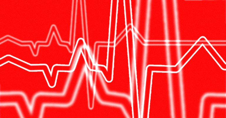 A team of researchers have developed an AI that can detect hyoglycaemic events — drops in blood sugar — in raw ECG data from a wearable.