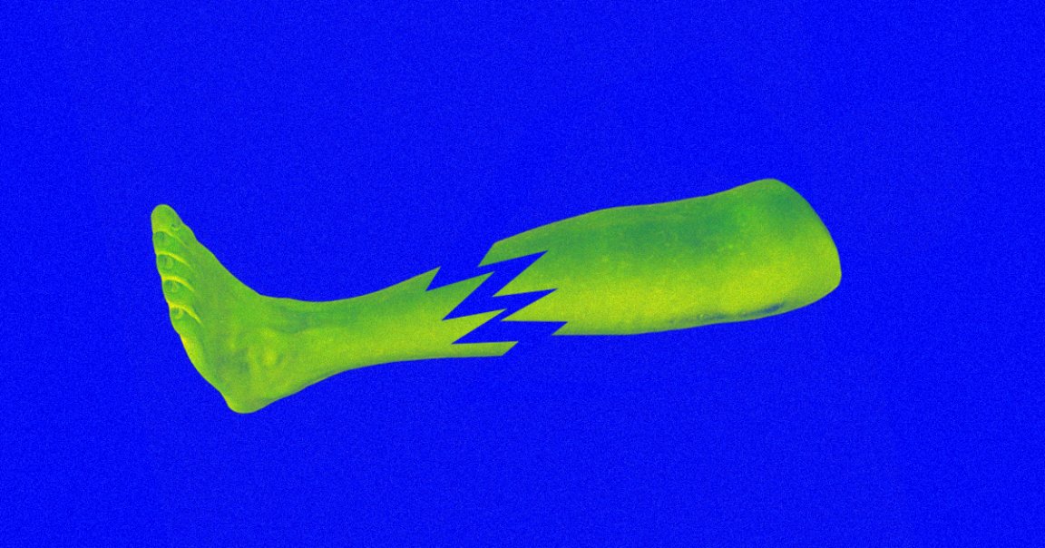 Orthopedic surgeons have begun offering leg lengthening — long offered as a corrective procedure for congenital defects — to insecure, short men.